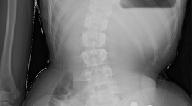 Timeline: Brianna's Spine timeline