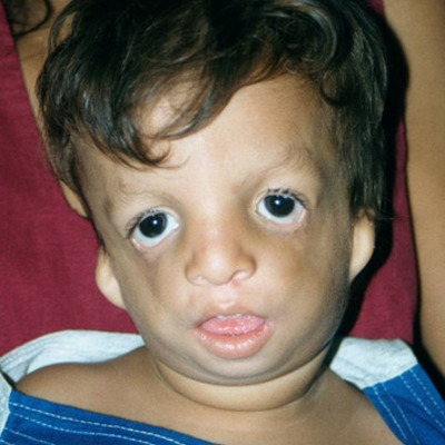 Timeline: Treacher Collins