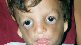 Timeline: Treacher Collins