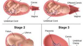 Timeline: 3 Stages of Labor