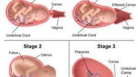 Timeline: Labor to Birth