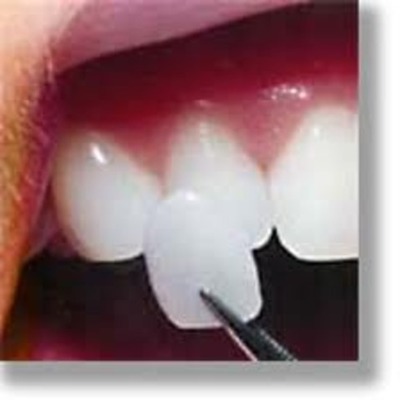 Timeline: Veneers