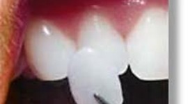 Timeline: Veneers