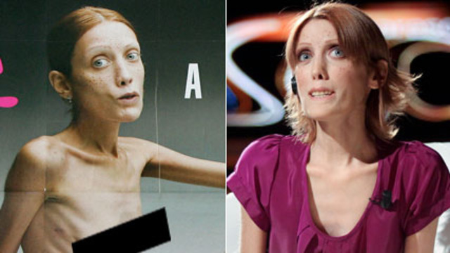 Anorexia Nervosa Pictures Famous People Anorexia Nervosa Pictures Famous People
