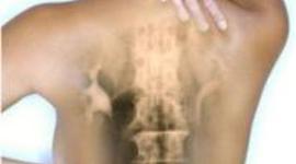 Timeline: corrección de postura de espalda