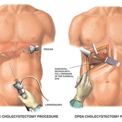 Timeline: Laparoscopic Surgery