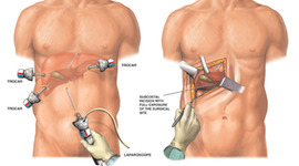Timeline: Laparoscopic Surgery