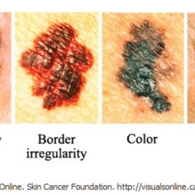 Timeline: Cancer Screenings