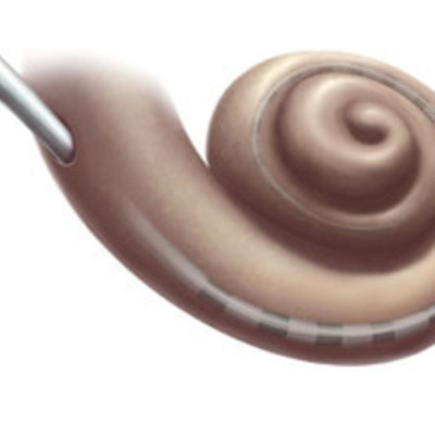 Timeline: Dr. Grame Clark (cochlear)