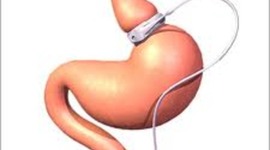 Timeline: History of the Lap-Band