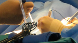 Timeline: Technological Advances in Organ Transplantation