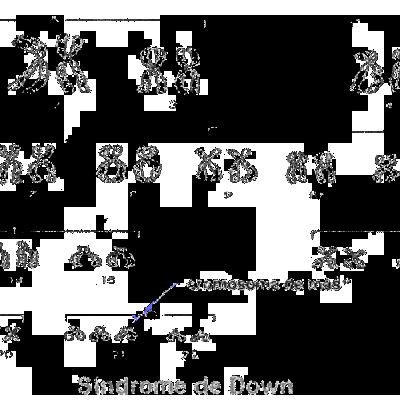 Timeline: Historia del sindrome de down