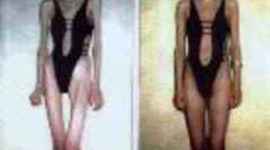 Timeline: Anorexia