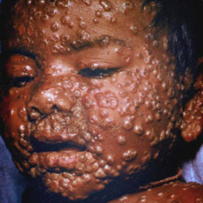 Timeline: Smallpox