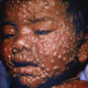 Smallpox day9sm