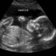 2d ultrasound3
