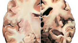 Timeline: The History of Alzheimer's disease