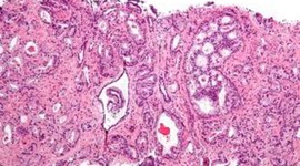 Timeline: History of Cancer