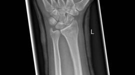 Timeline: History of the X-Ray