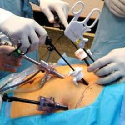 Timeline: LAPAROSCOPIA