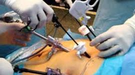 Timeline: LAPAROSCOPIA