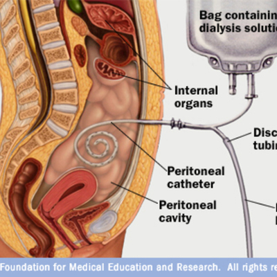 Timeline: Milestones on the Development of Peritoneal Dialysis