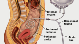 Timeline: Milestones on the Development of Peritoneal Dialysis