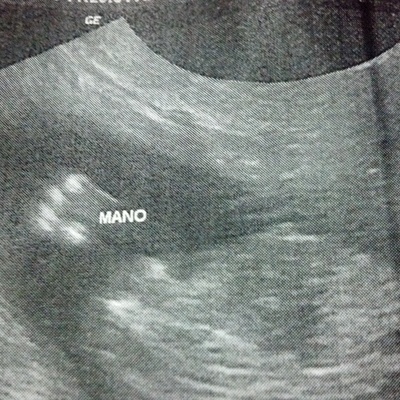 Timeline: 20 semanas de embarazo