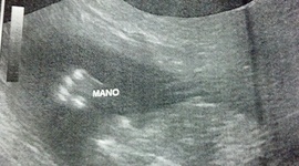 Timeline: 20 semanas de embarazo