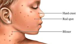 Timeline: Chickenpox Timeline