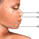 Chickenpox