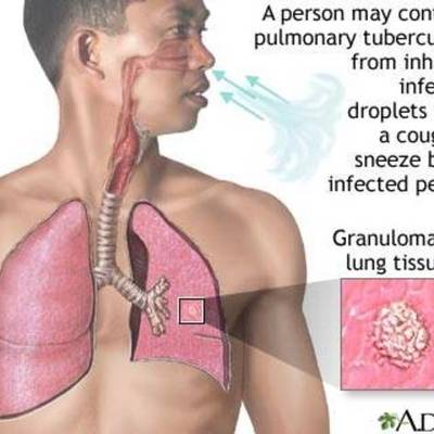 Timeline: Tuberculosis