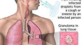Timeline: Tuberculosis