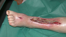 Timeline: Necrotizing Fasciitis (Flesh Eating Disease)