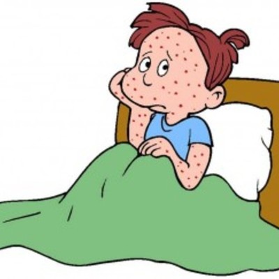 Timeline: History of Varicella