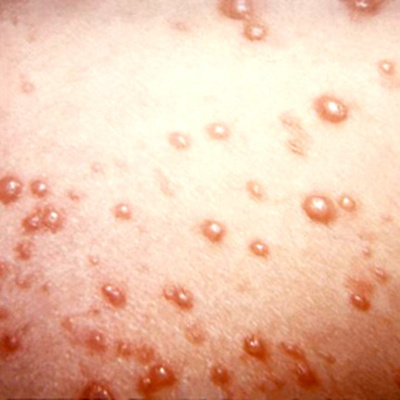 Timeline: Chicken Pox