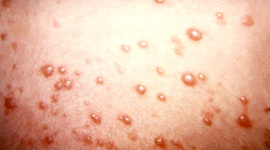 Timeline: Chicken Pox
