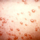 Chicken pox pustules