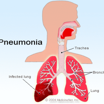 Timeline: Pneumonia