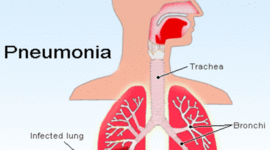 Timeline: Pneumonia