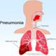 Pneumonia