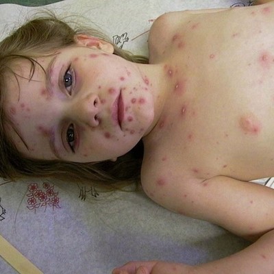Timeline: Varicella (Chicken Pox)