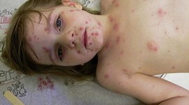 Timeline: Varicella (Chicken Pox)