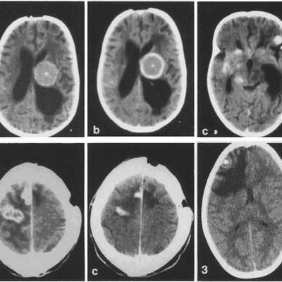 Timeline: Brain Cancer