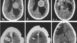 Timeline: Brain Cancer