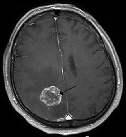 Brain Cancer timeline Timetoast timelines