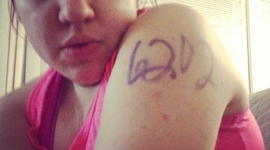 Timeline: Ovarian Fyst's Ankle Injury