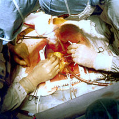 Timeline: Historia de la Cirugia Cardiaca