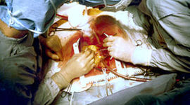 Timeline: Breve historia de la cirugía de corazón