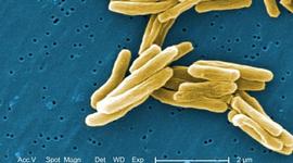 Timeline: Tuberculosis